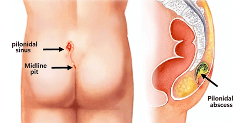 Pilonidal Sinus Surgery in Pune | Kimaya Clinic Wanowrie | Dr. Milind Joshi