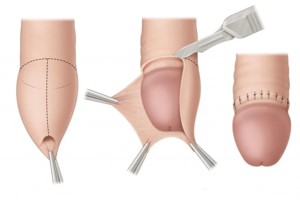 Phimosis & Paraphimosis Treatment in Pune | Laser Circumcision | Kimaya Clinic Wanowrie & Salunkhe Vihar