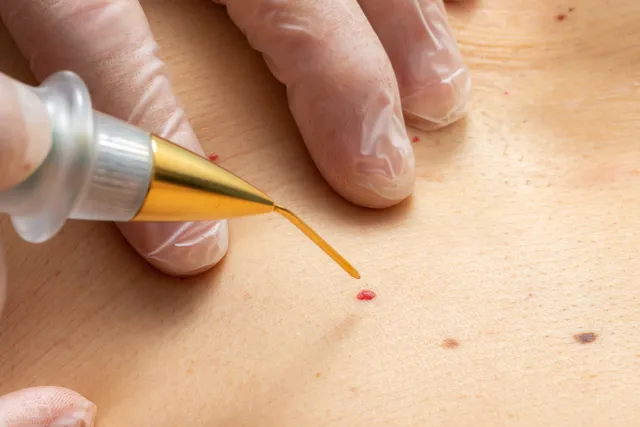 Anal Warts Removal in Pune | Kimaya Clinic | Dr. Milind Joshi