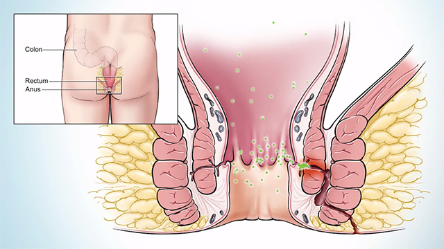 Best Fistula Surgeon in wanowrie, pune