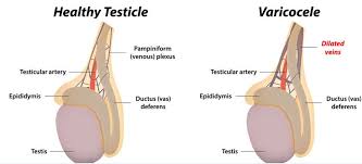Varicocele Surgery in wanowrie, pune