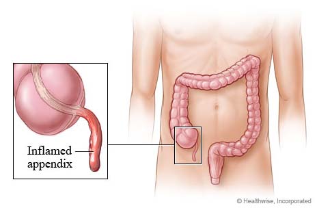 Laparoscopic Appendectomy in Pune | Kimaya Clinic – Dr. Milind Joshi