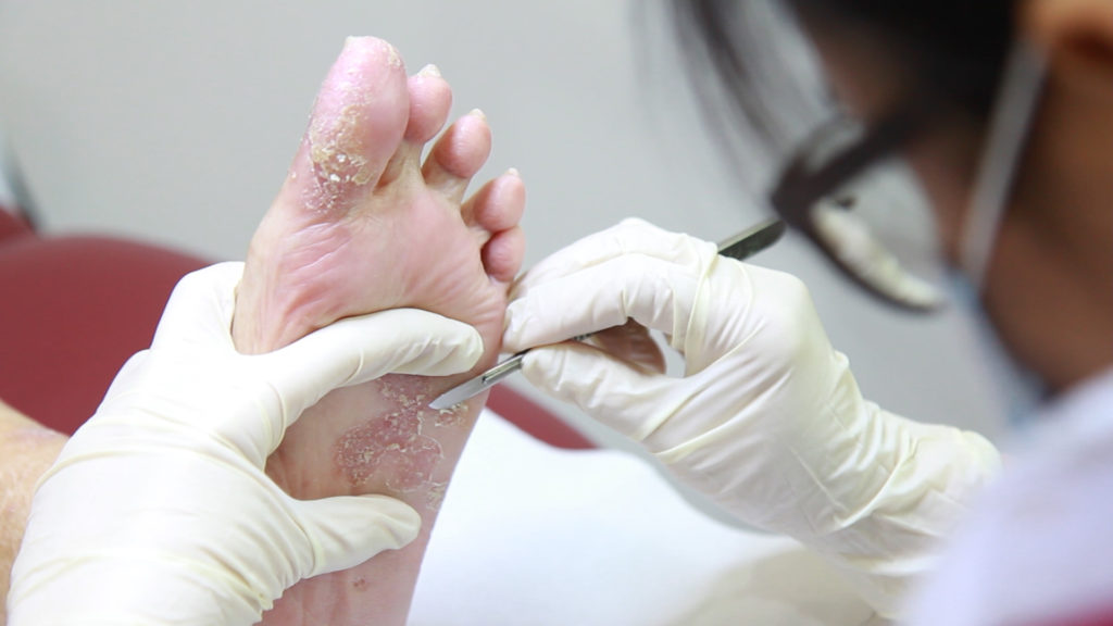 Diabetic Foot Ulcer Surgical Debridement in Pune | Dr. Milind Joshi