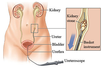 Stent Removal Surgery in Pune | DJ Stent Removal in Wanowrie & Salunkhe Vihar | Kimaya Clinic